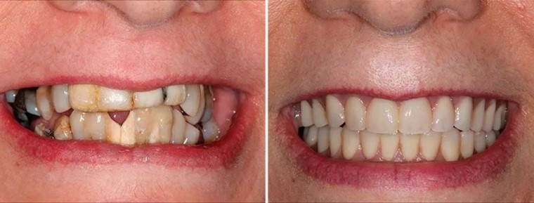 Real patient smile before and after all-on-four dental implants