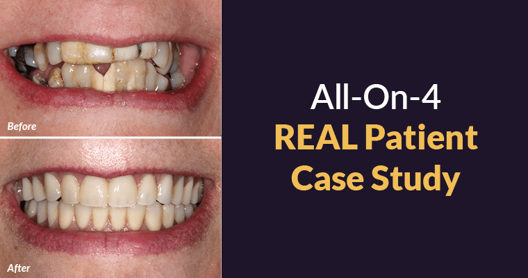 All-on-4® Before and After Case Study [and How to Get Results like These!]