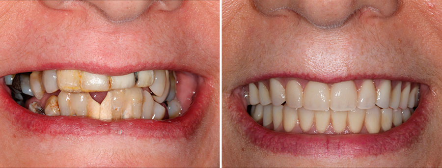 Before and after case using All-on-4 dental implants